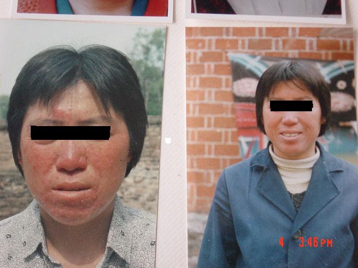 中州藥膏使用前后對比4