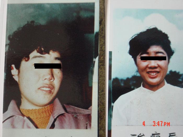 中州藥膏使用前后對比3